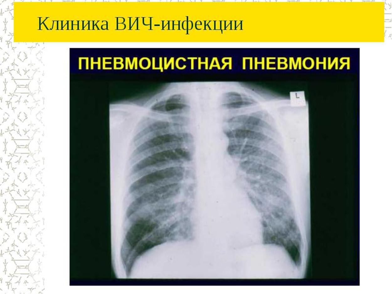 Спид клиника. Пневмоцистная пневмония при ВИЧ клиника. Клиника вича. СПИД клиника диагностика лечение силикат.