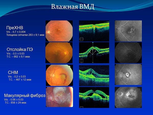Лечение дегенерации макулы. Возрастная макулярная дегенерация сетчатки глаза. Возрастная макулярная дегенерация формы. Макулярная дегенерация сухая форма.